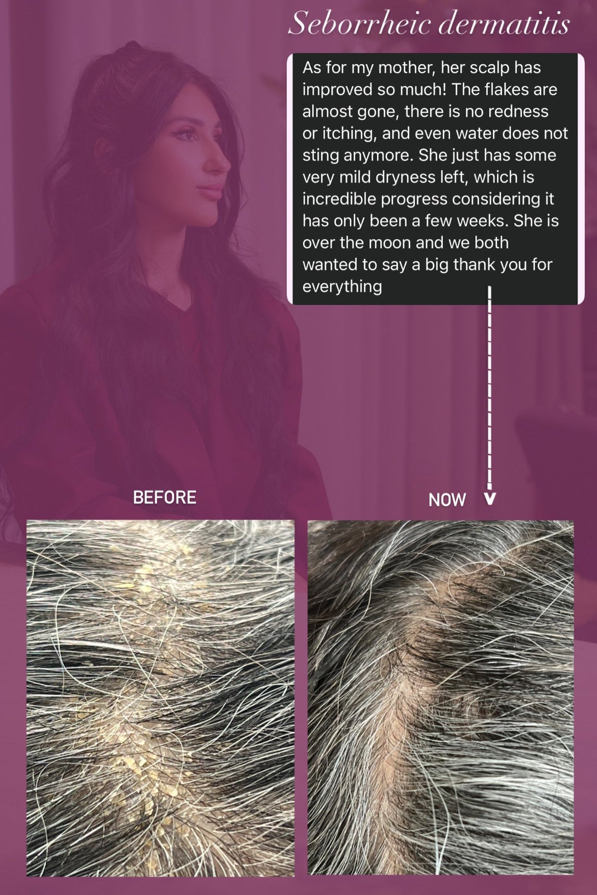 Before and after comparison of a person with Seborrheic Dermatitis 